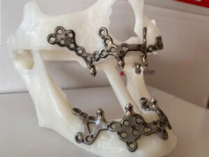 implantes subperiosticos