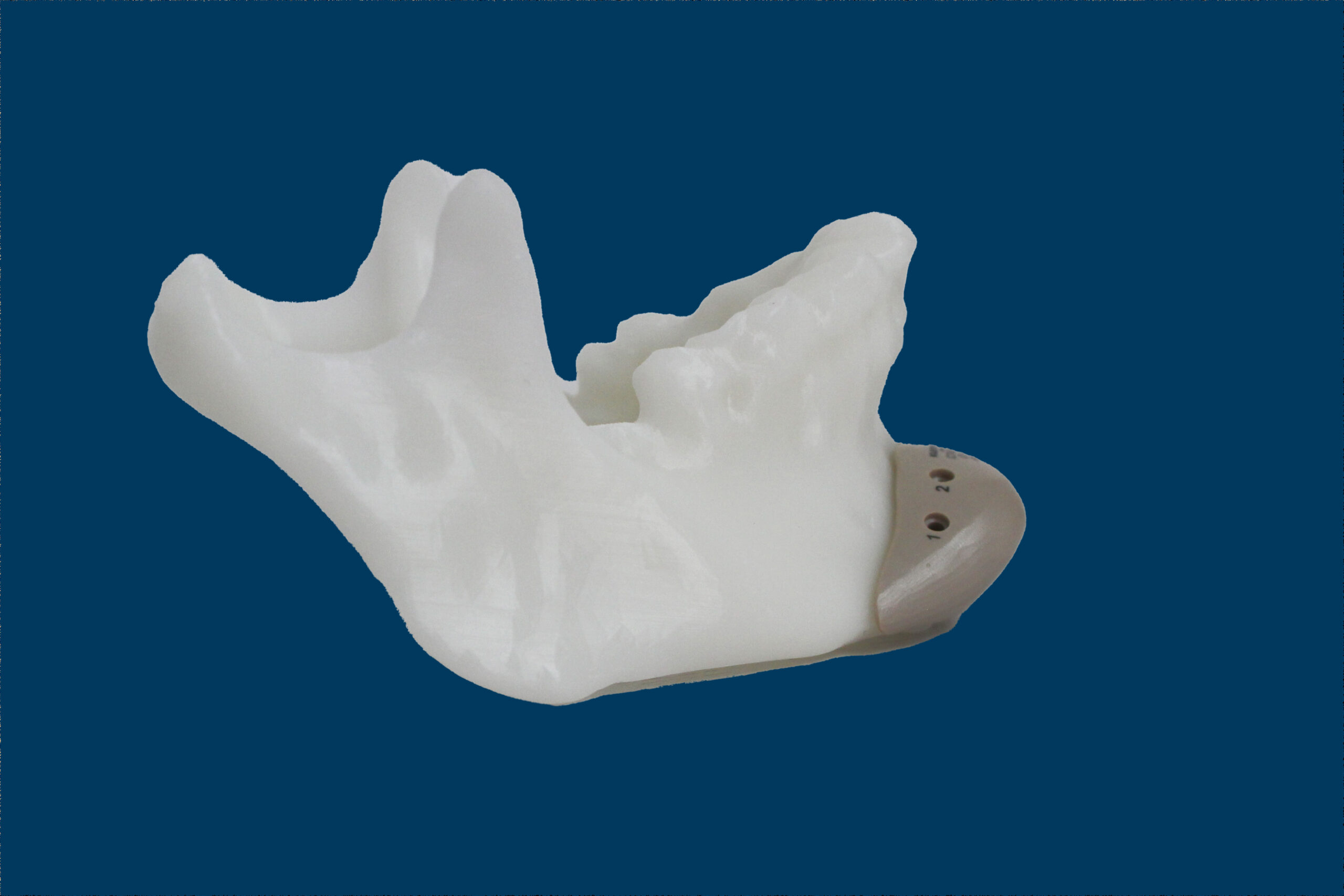 implantes de menton